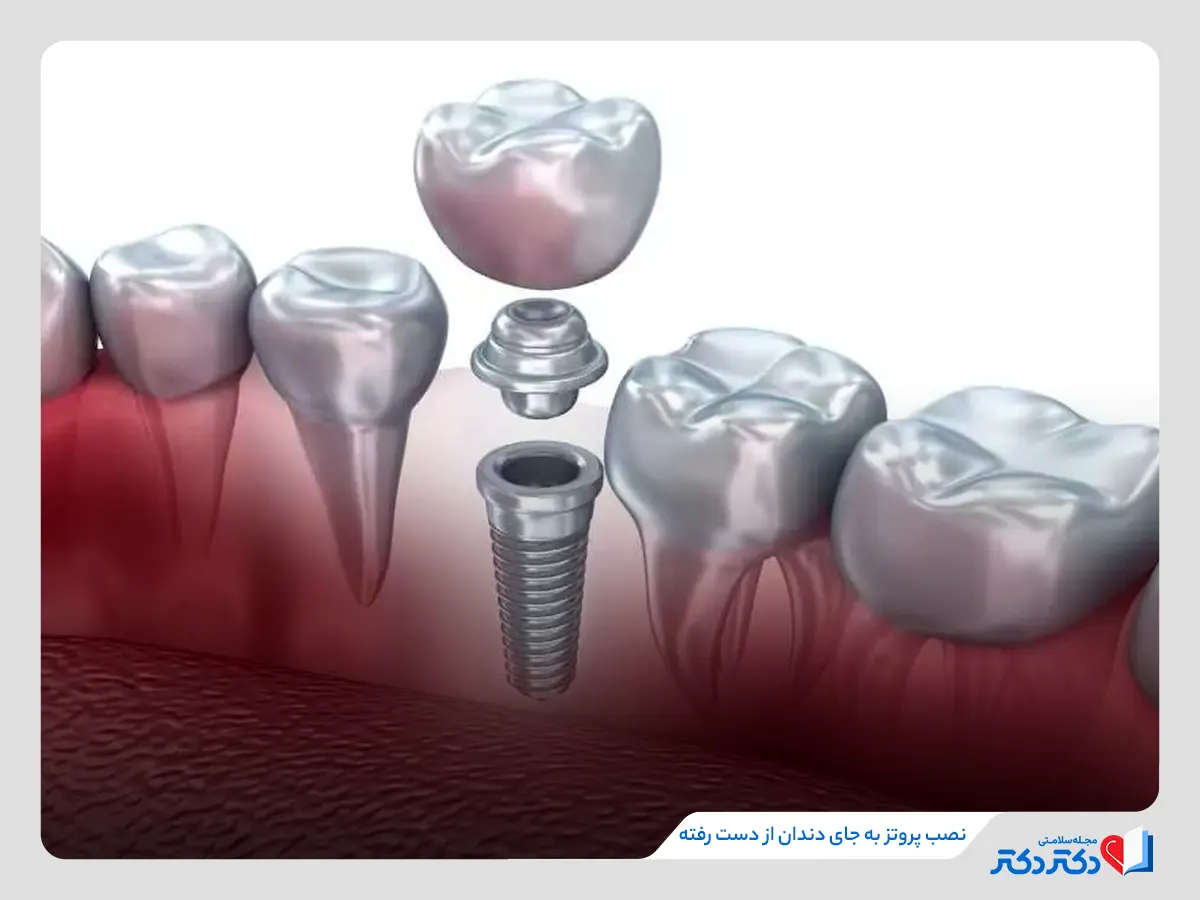 نصب ایمپلت به جای دندان از وظایف تخصص دندانپزشکی درمانی
