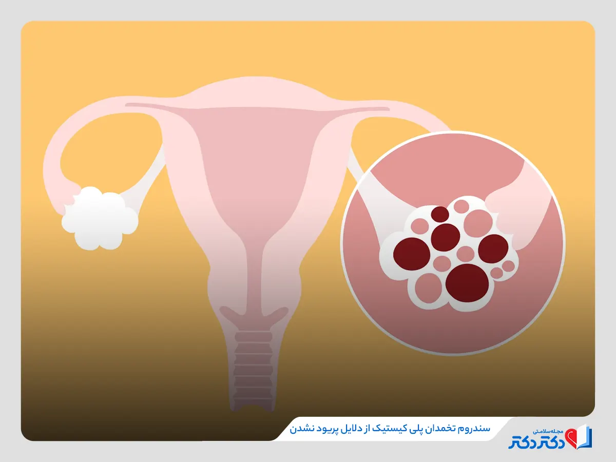 تخمدان پلی کیستیک از دلایل پریود نشدن