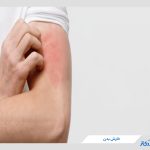 علت خارش بدن چیست؟ + معرفی روش های درمان خارش پوست
