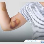 24 روش درمان کبودی در خانه با مواد اولیه در دسترس