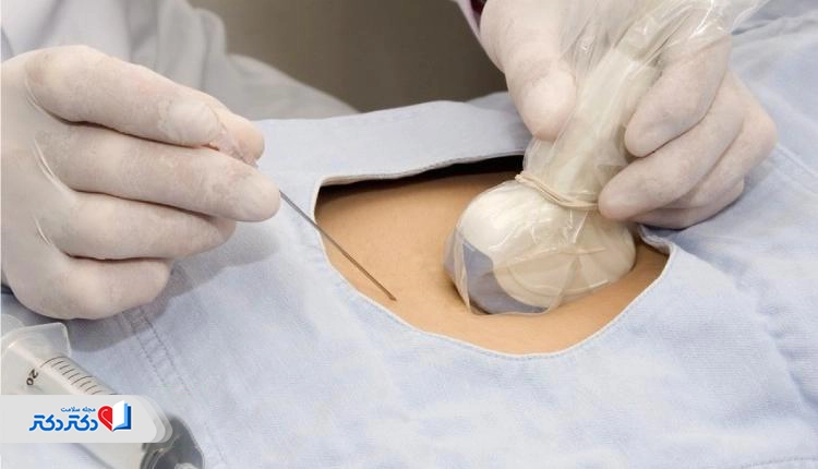 نمونه آزمایش آمنیوسنتز