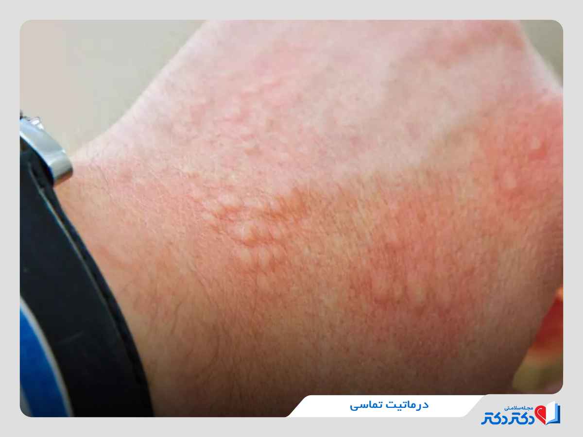 درماتیت تماسی