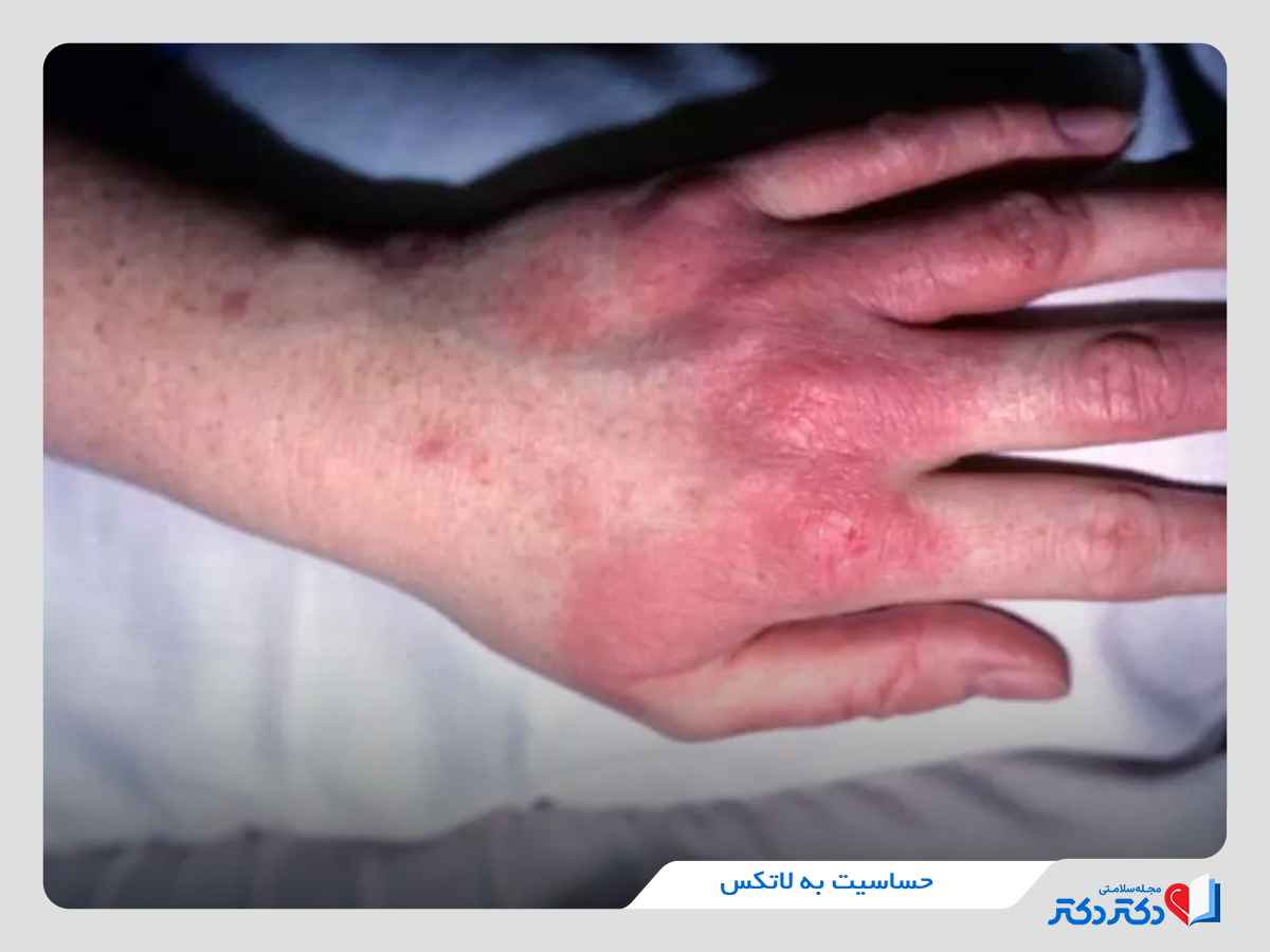 حساسیت به لاتکس