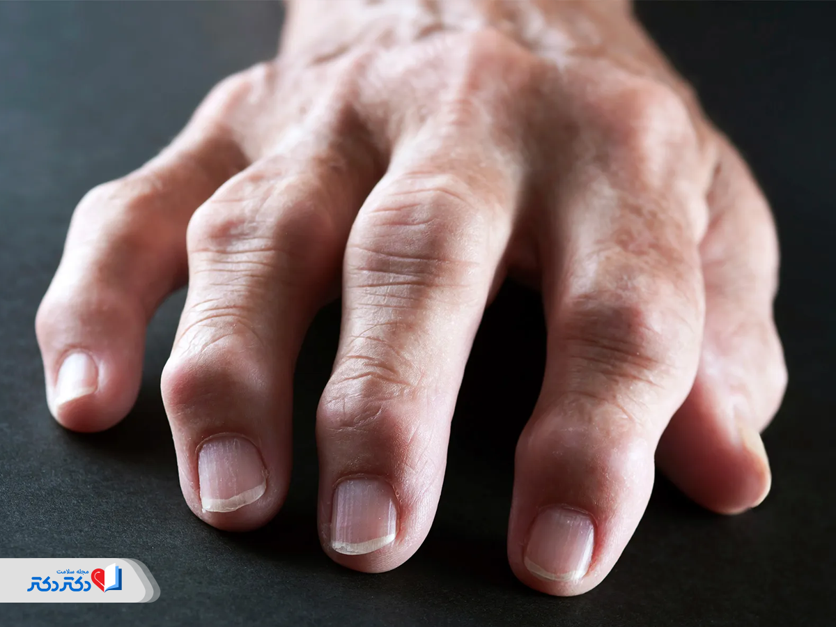 آرتریت یا التهاب مفاصل، از عوارض شایع تب مالت