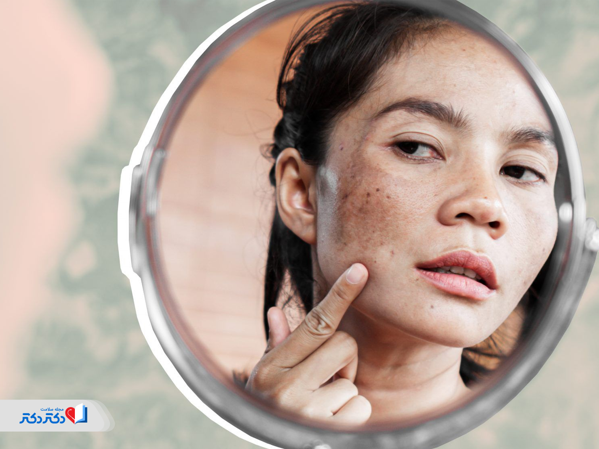 لکههای تیره پوست روی صورت از عوارض قرص مارولین