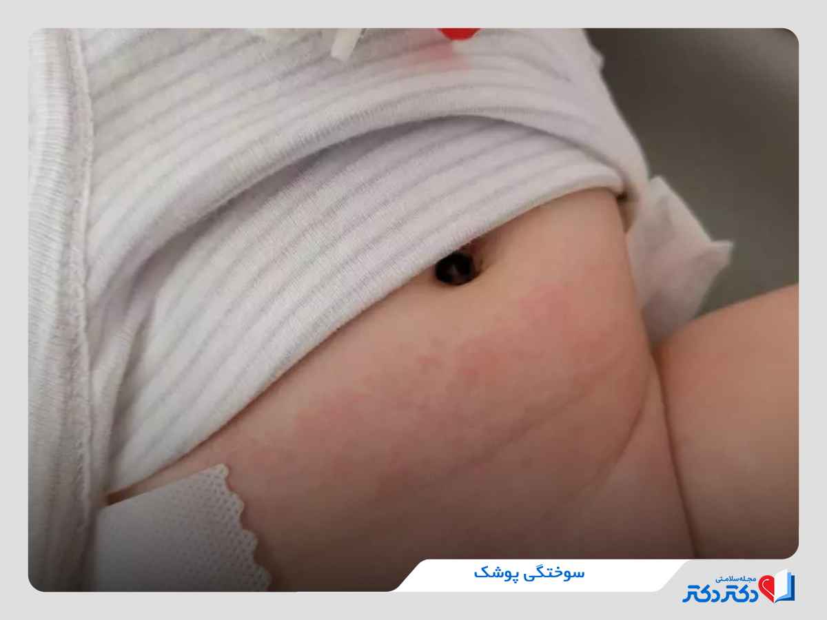 بثورات پوشک