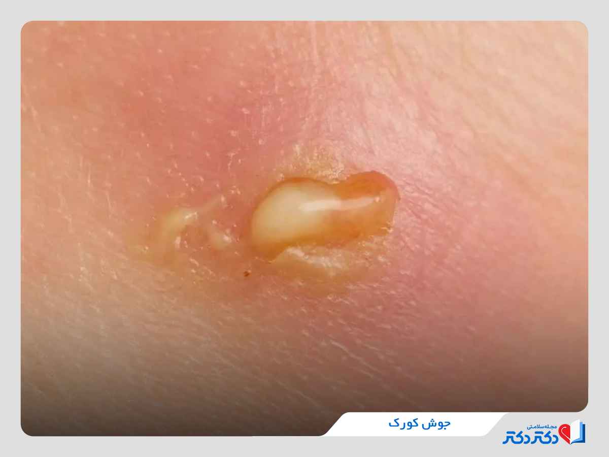 جوش کورک