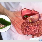 پولیپ کیسه صفرا چیست؟ + علت و درمان