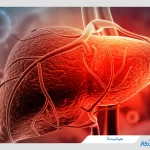 هپاتیت C ؛ علائم، تشخیص و درمان هپاتیت سی