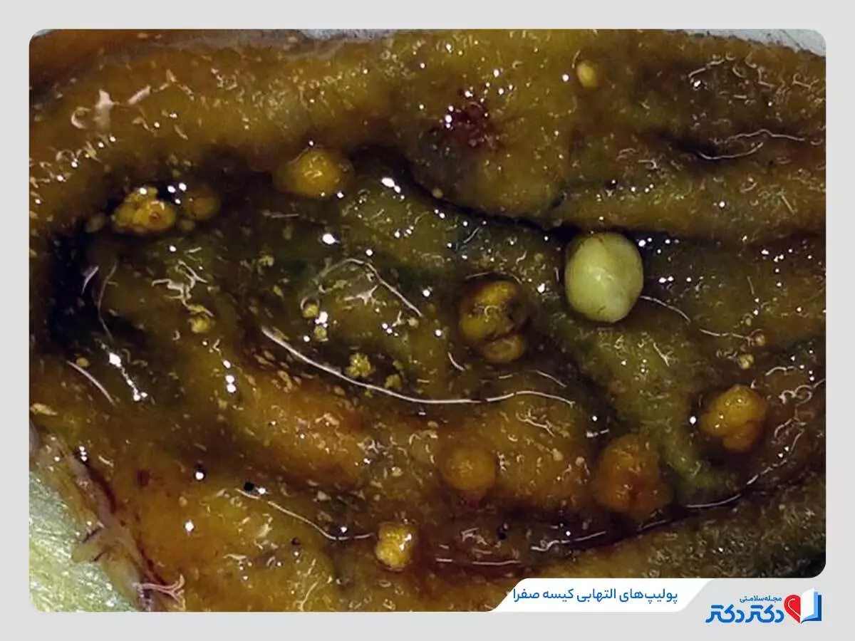 پولیپ‌های التهابی کیسه صفرا ناشی از التهاب مزمن دیواره داخلی کیسه صفرا