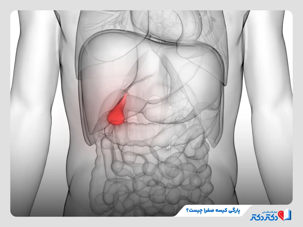 پارگی کیسه صفرا ترکیدن کیسه صفرا علائم پارگی کیسه صفرا