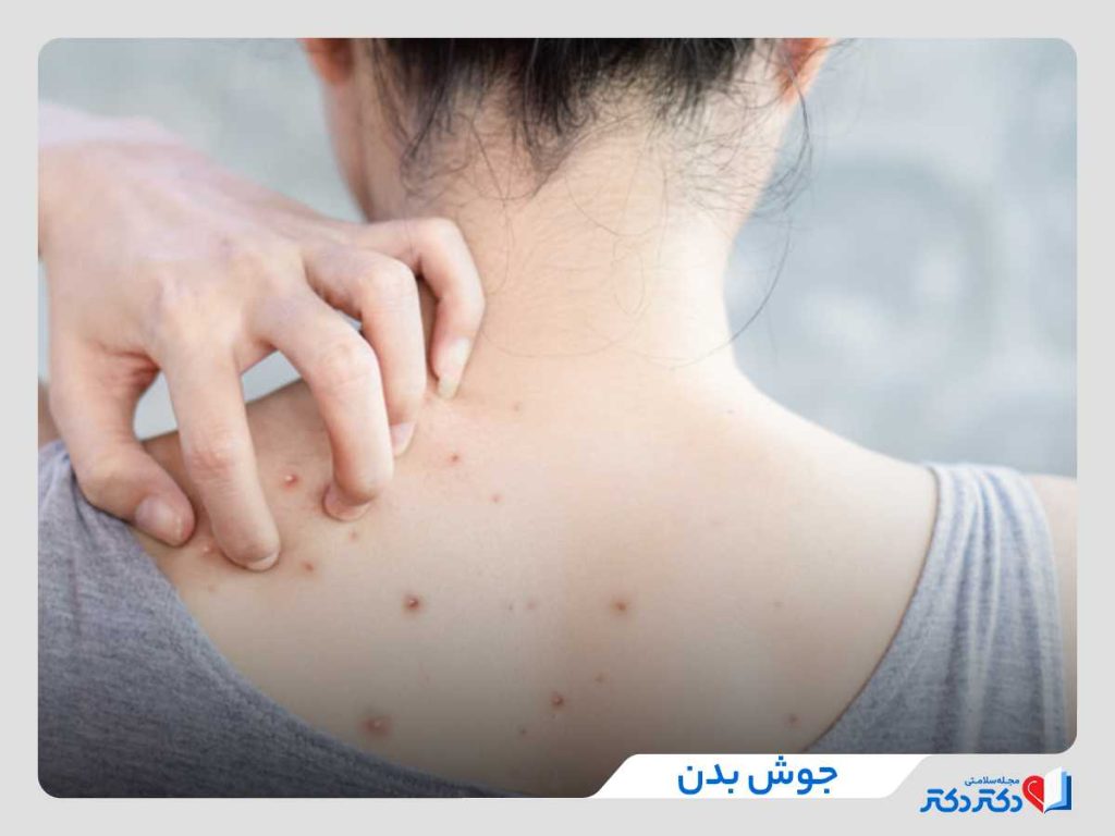 جوش بدن چیست