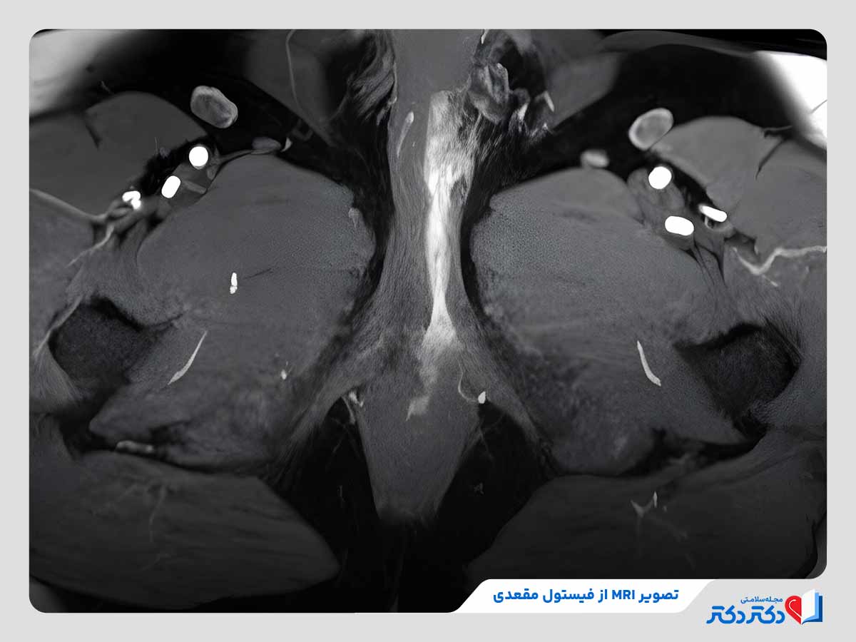 عکسی از اسکن فیستول مقعدی در سی تی اسکن