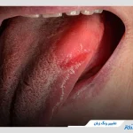 علت تغییر رنگ زبان چیست؟ بررسی دلایل و روش‌های درمانی + نکات مهم