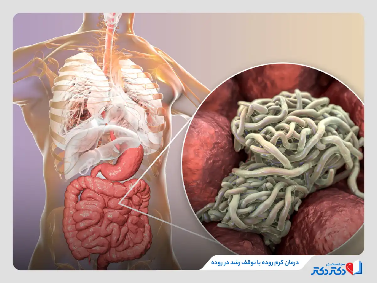 درمان انواع کرم روده با توقف رشد در روده
