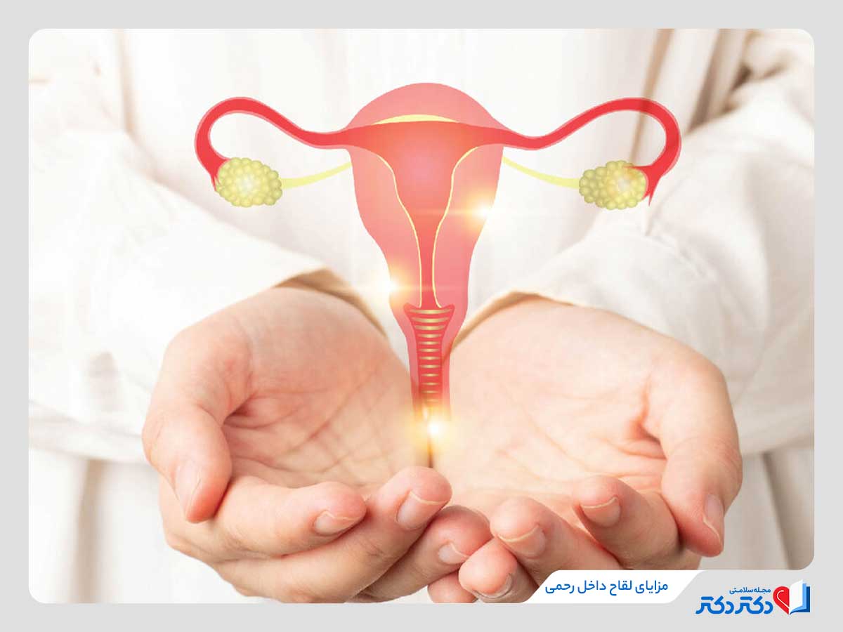 مزایای لقاح داخل رحمی (IUI) شامل سادگی و کم‌تهاجمی بودن