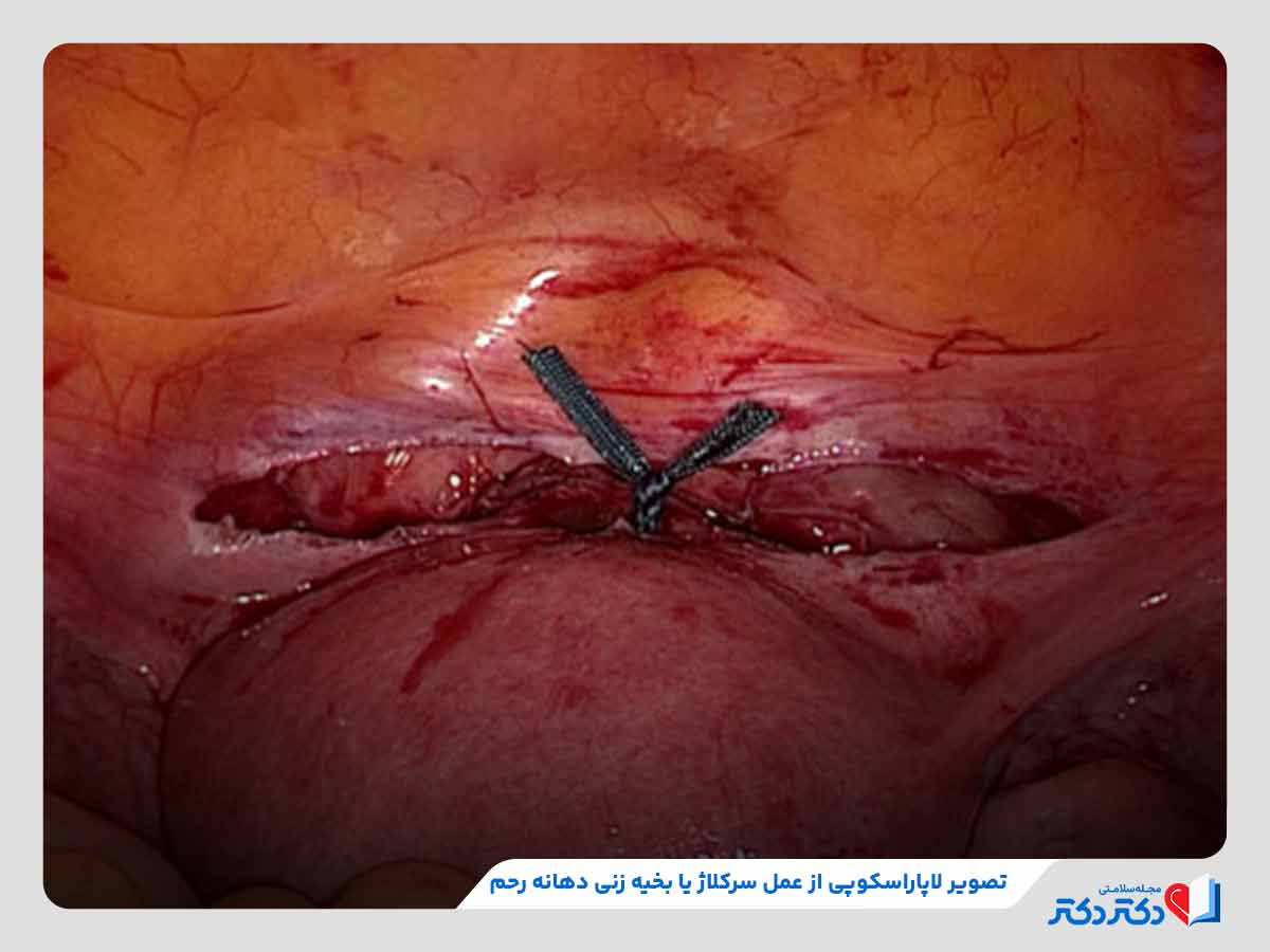 عمل سرکلاژ یا بخیه‌زنی دهانه رحم، یکی از اقدام‌های مهم در جهت پیش‌گیری از زایمان زودرس