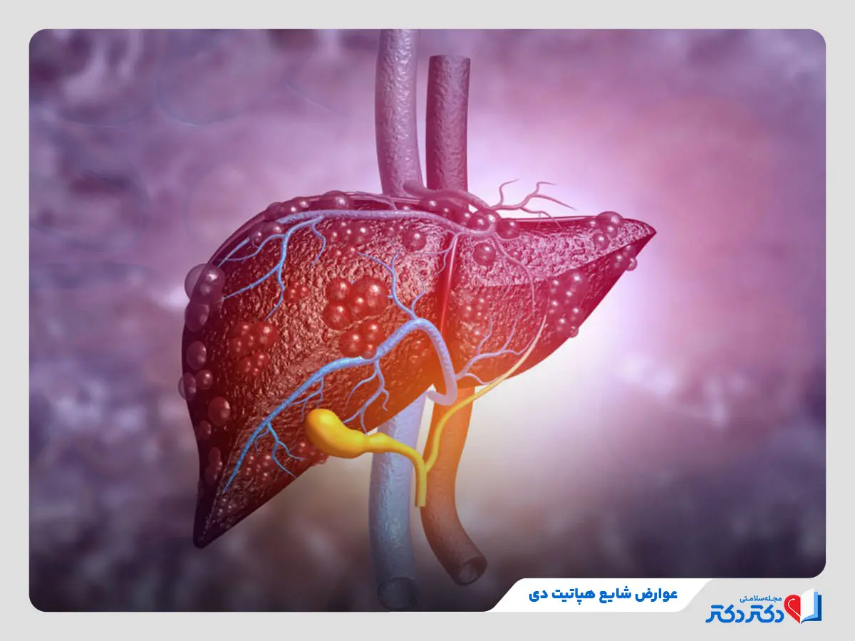 شناخت عوارض شایع بیماری هپاتیت دی روی کبد