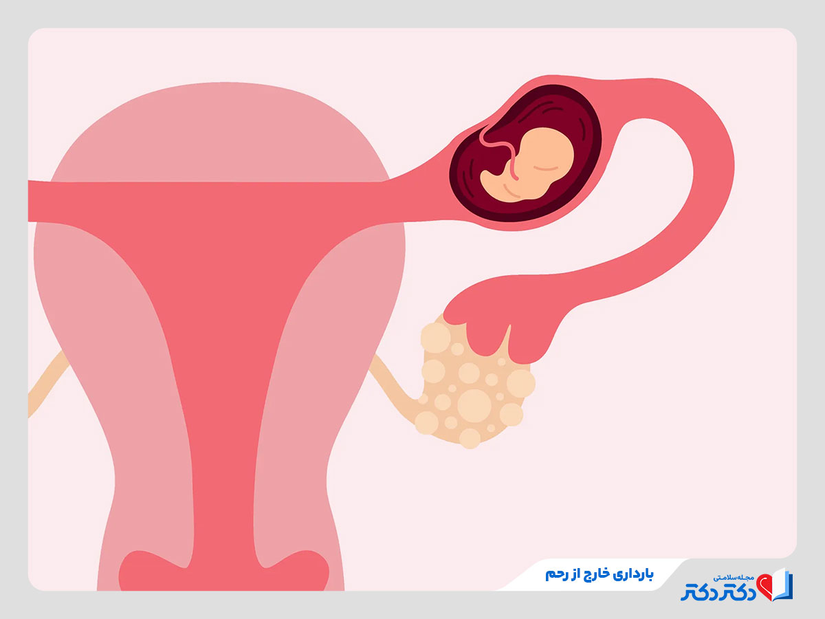 وقوع بارداری خارج از رحم یکی از انواع بارداری در زنان