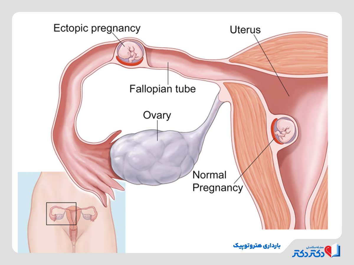 وقوع همزمان بارداری طبیعی و خارج از رحم دو نوع از انواع بارداری