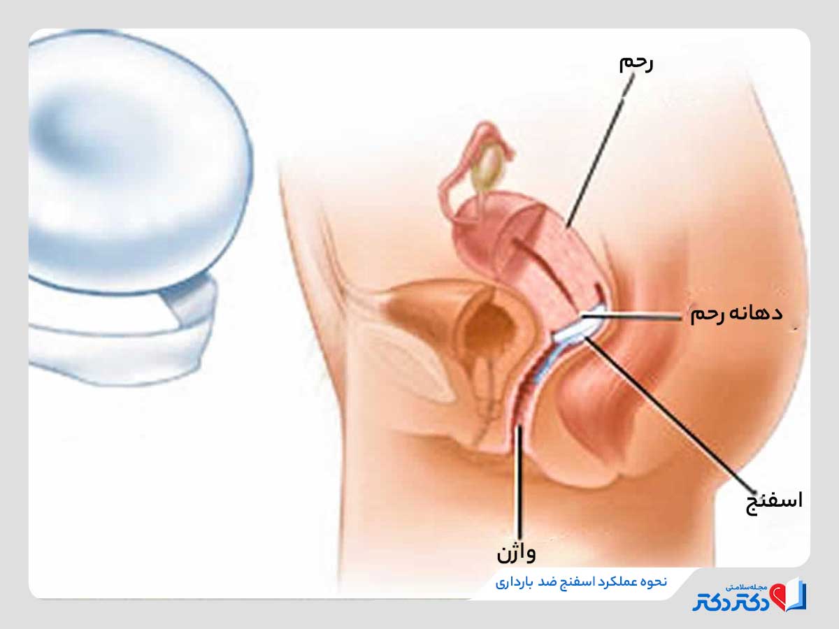 قرار گرفتن اسفنج ضد بارداری در دهانه رحم ممانعت از رسیدن اسپرم به تخمک