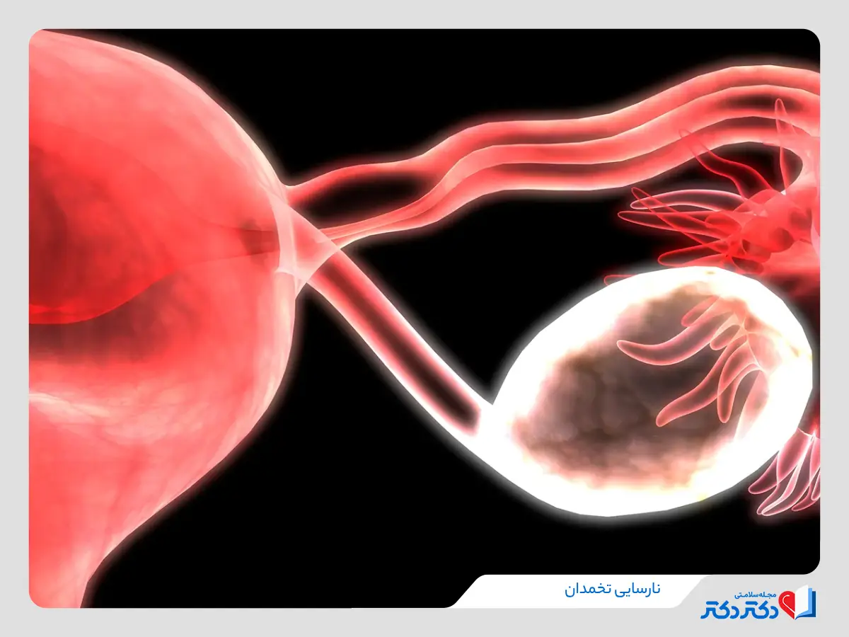 نارسایی تخمدان و از کارافتادن تخمدان‌ها