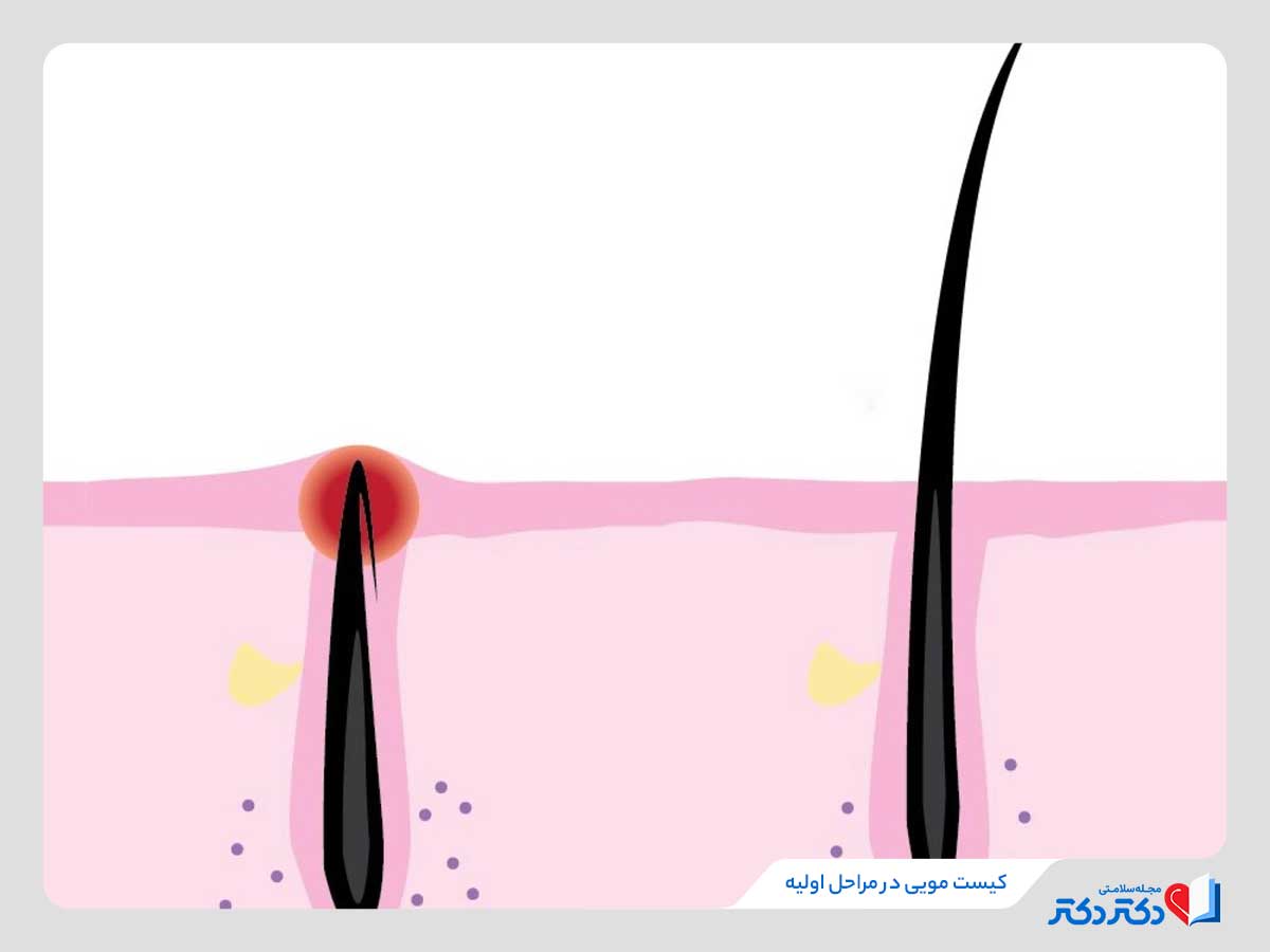 عکس کیست مویی در مراحل اولیه 