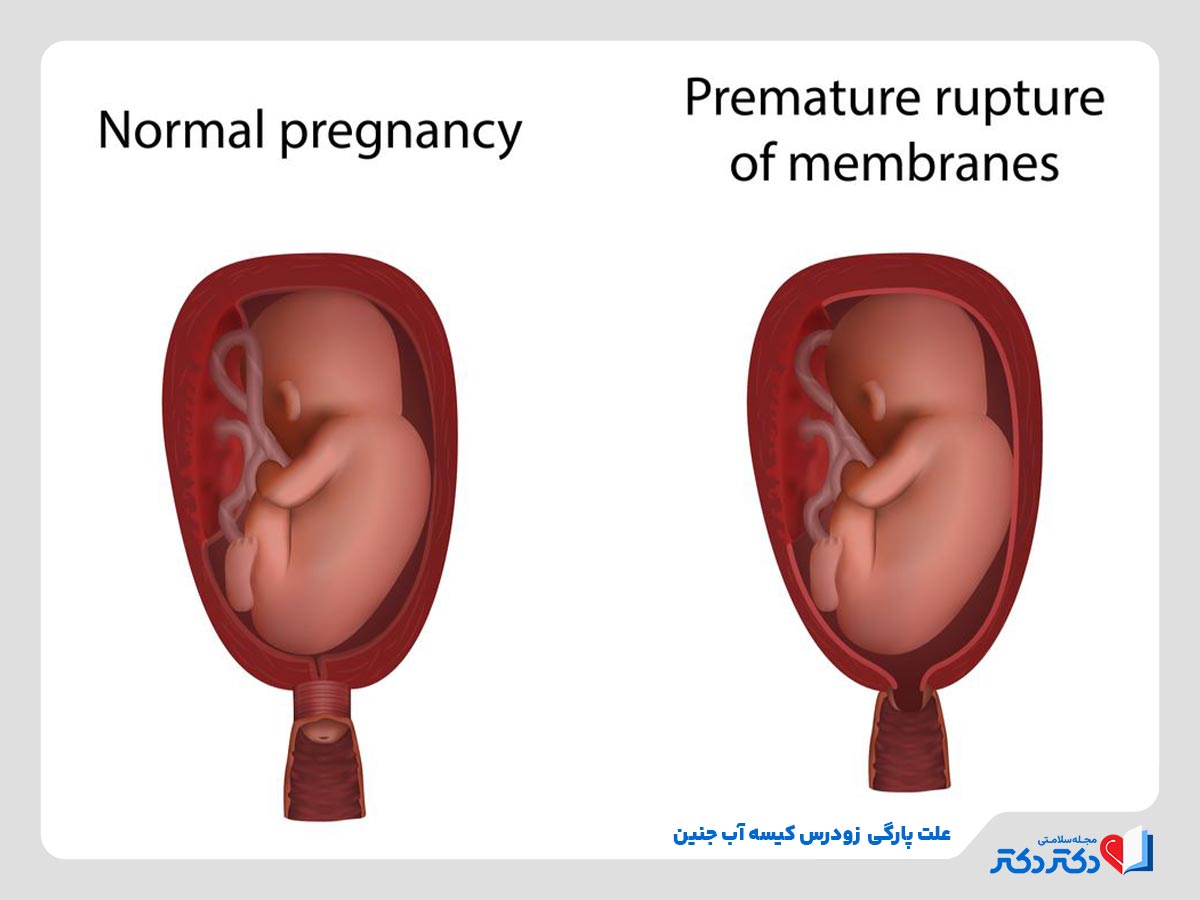 عوامل تاثیرگذار بر پارگی کیسه آب جنین