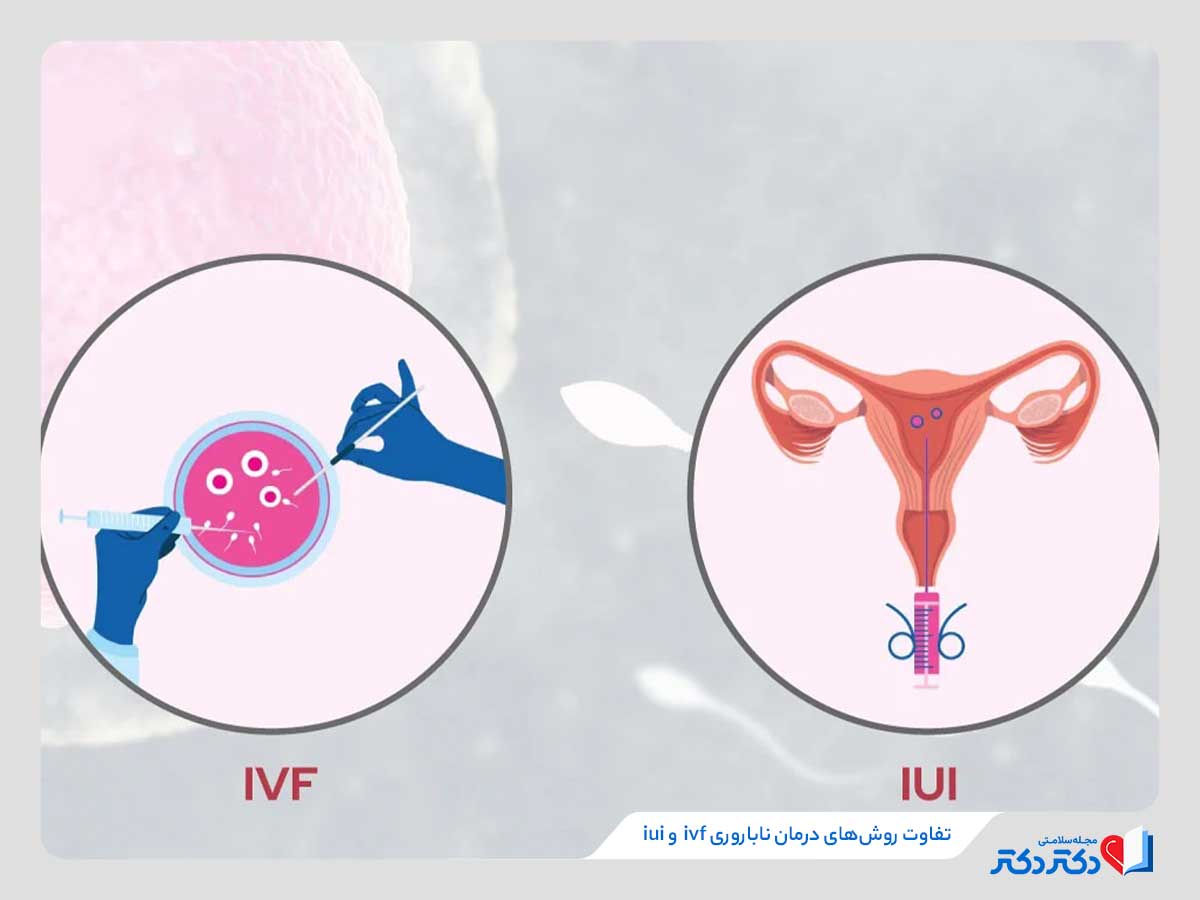 تفاوت روش‌های ivf و iui در درمان ناباروری