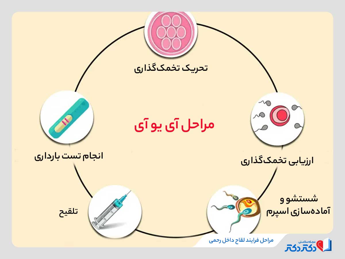 مراحل فرایند لقاح داخل رحمی (IUI) 