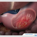 اسپاسم معده چیست؟ + 5 دلیل مهم گرفتگی معده