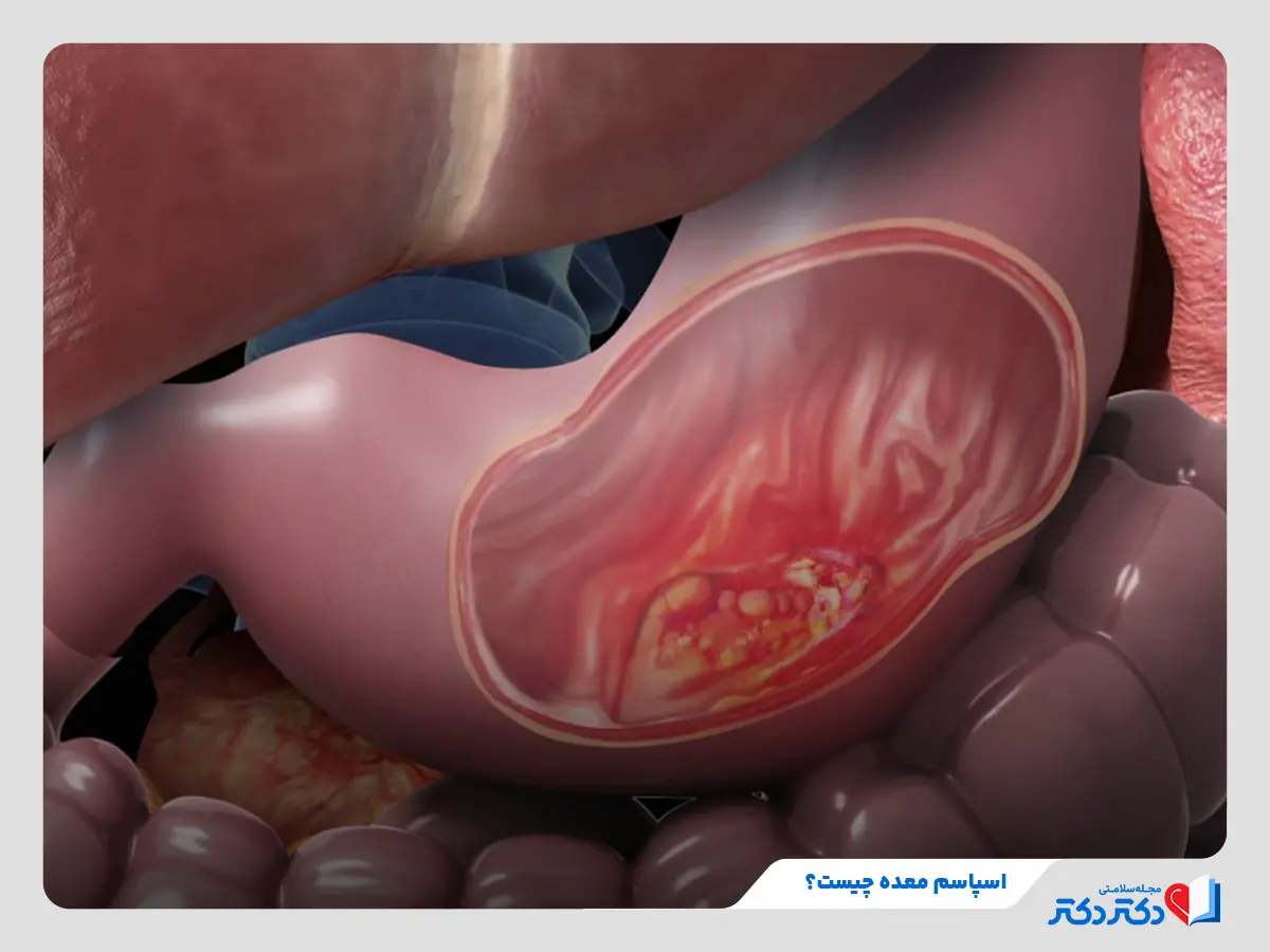 اسپاسم معده و دلایل و علائم رخ دادن این بیماری