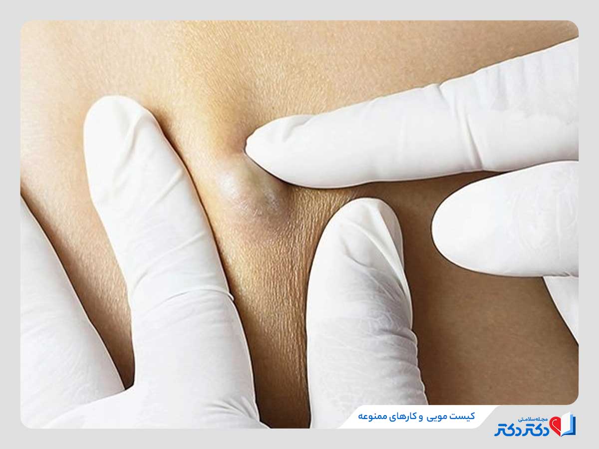 فشار دادن کیست مویی برای تخلیه، از کارهای ممنوعه برای افراد دچار این مشکل