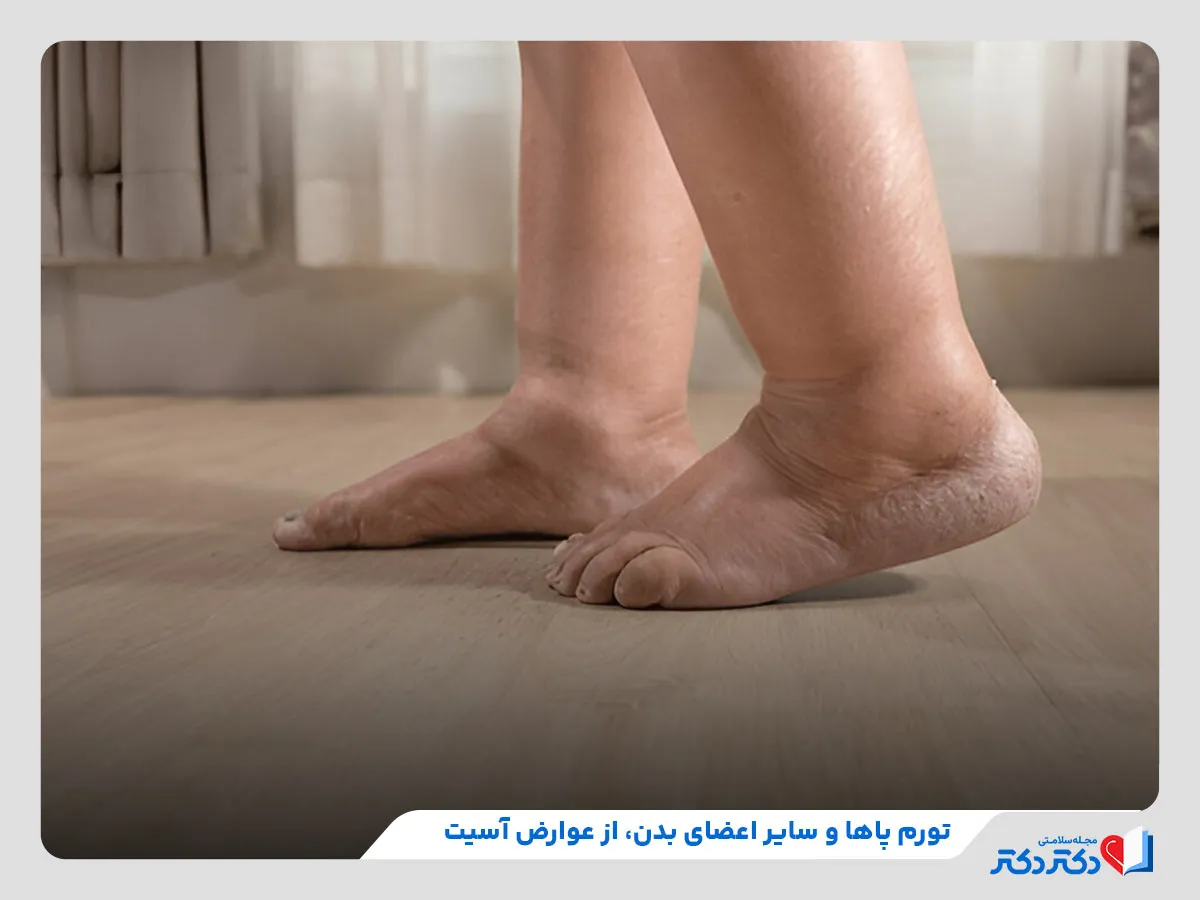 بررسی عوارض آب آوردن شکم مانند تورم پاها