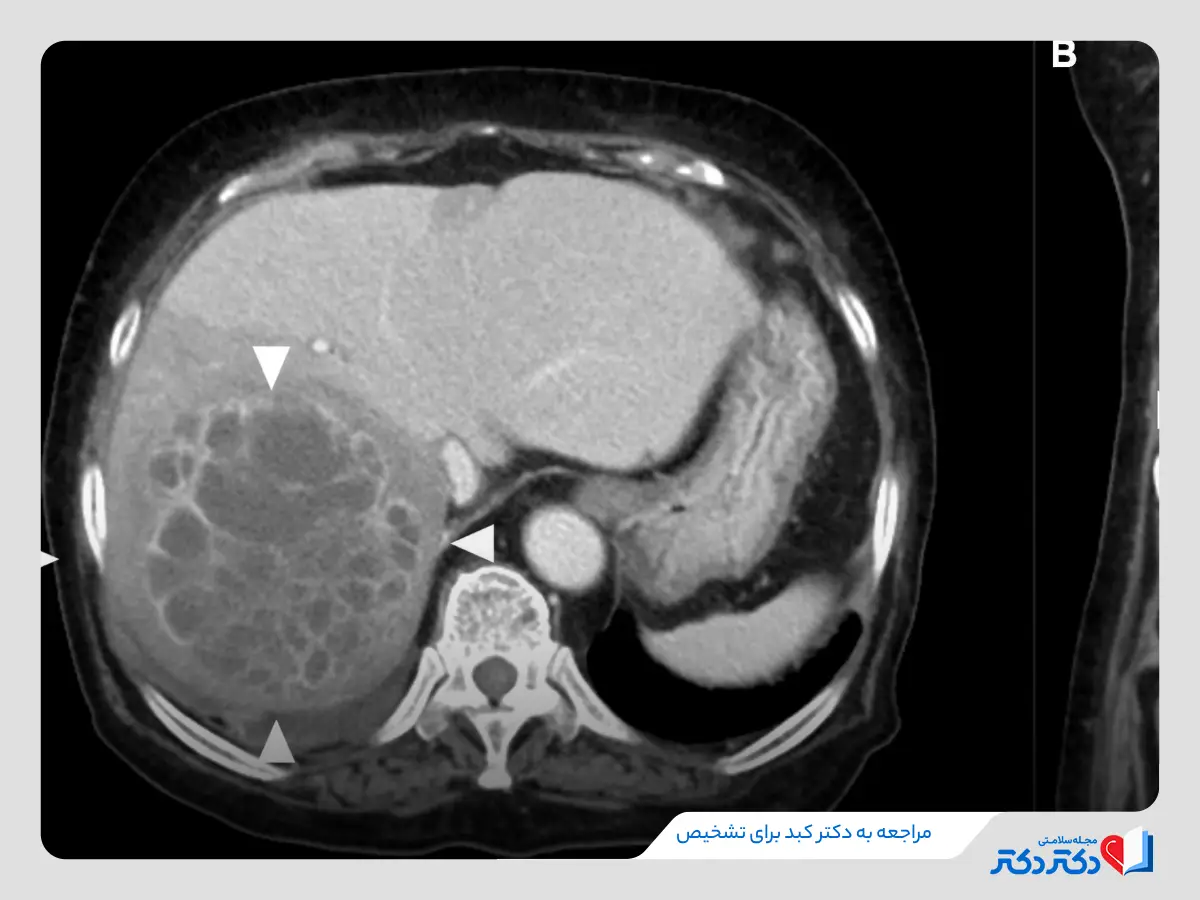 عکس از کبد دچار آبسه و چرک