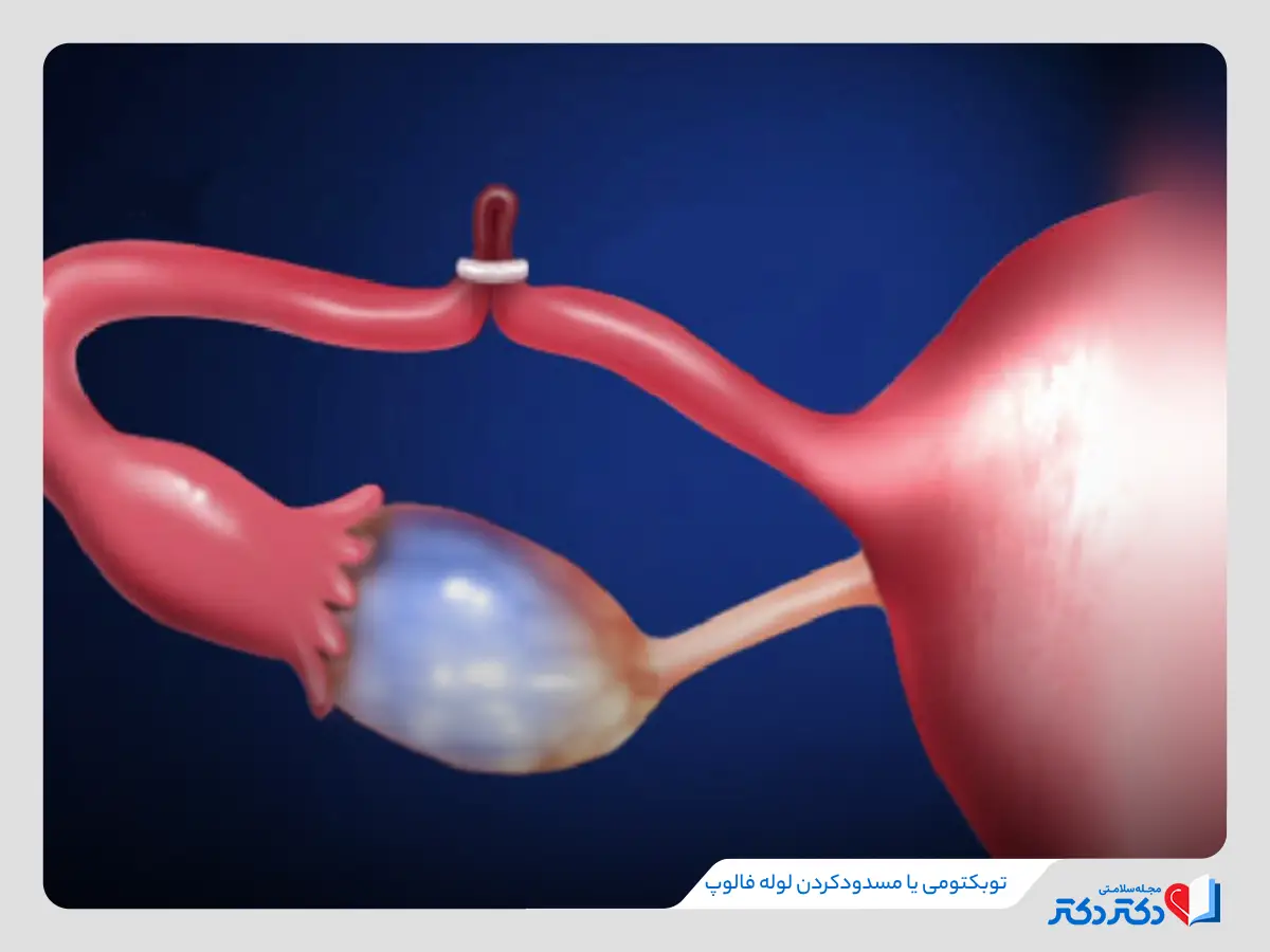 توبکتومی یا مسدودکردن لوله فالوپ برای پیشگیری از لقاح تخمک و اسپرم