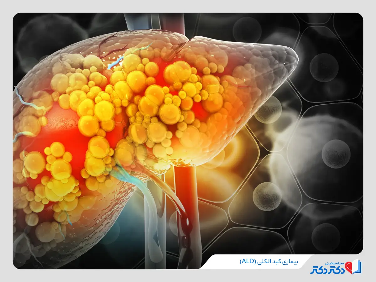 تغییر سبک زندگی برای جلوگیری از ابتلا به بیماری کبد الکلی (ALD)