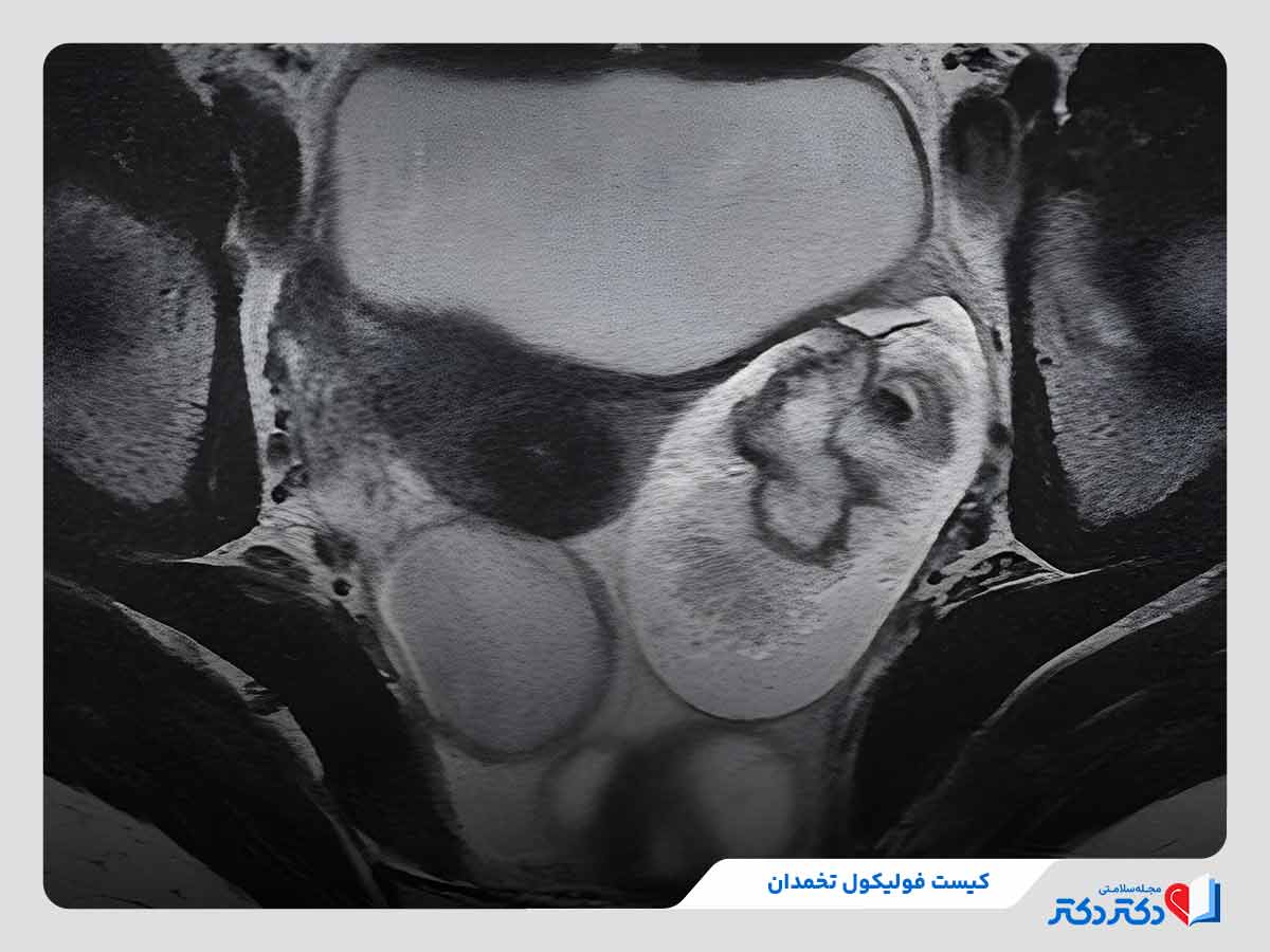 تصویری از کیست‌های حاوی مایع در فولیکول تخمدان 