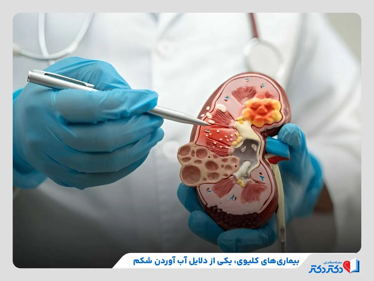 بررسی دلایل بروز آب آوردن شکم مانند بیماری‌های کلیوی