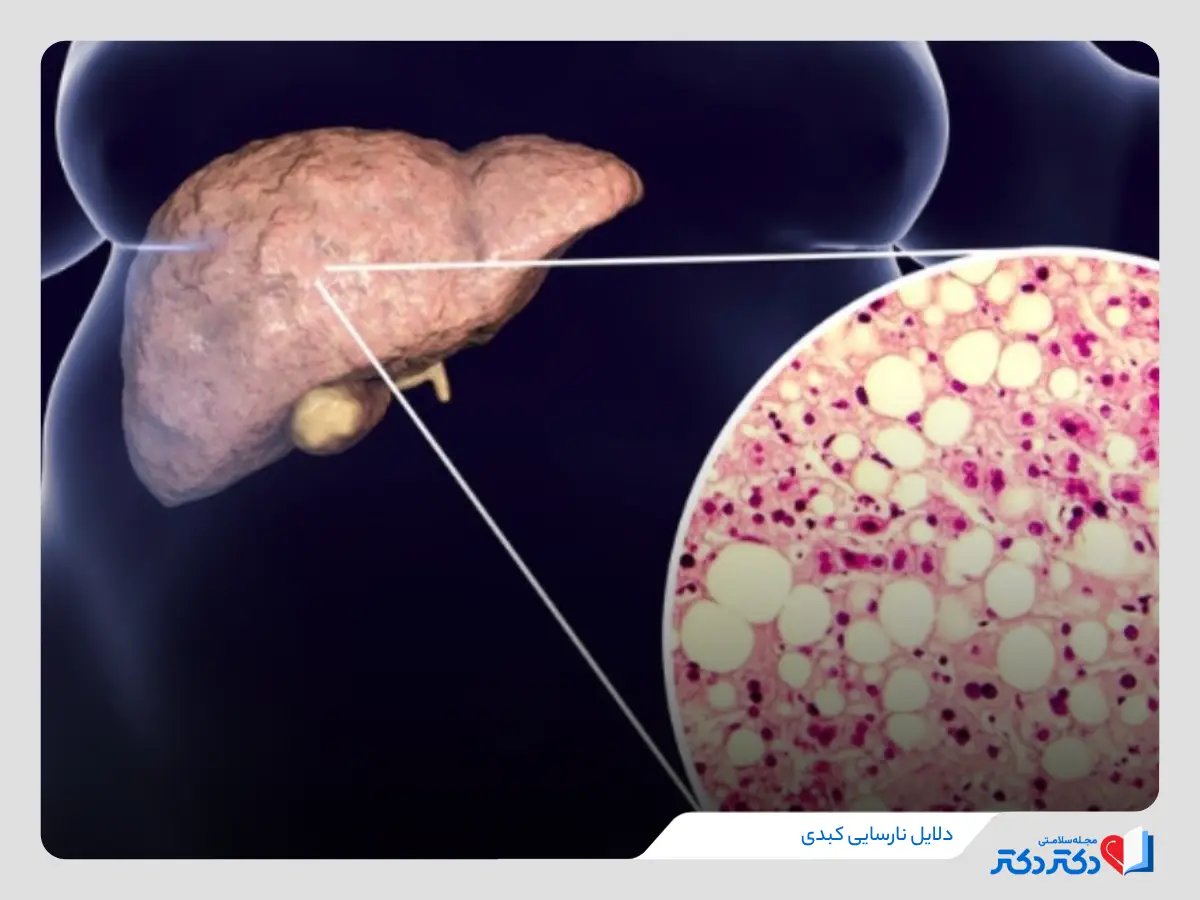 پیشرفت نارسایی کبدی و از کارافتادن آن