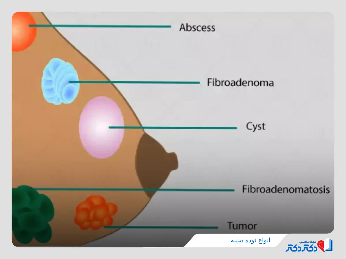 انواع توده در سینه