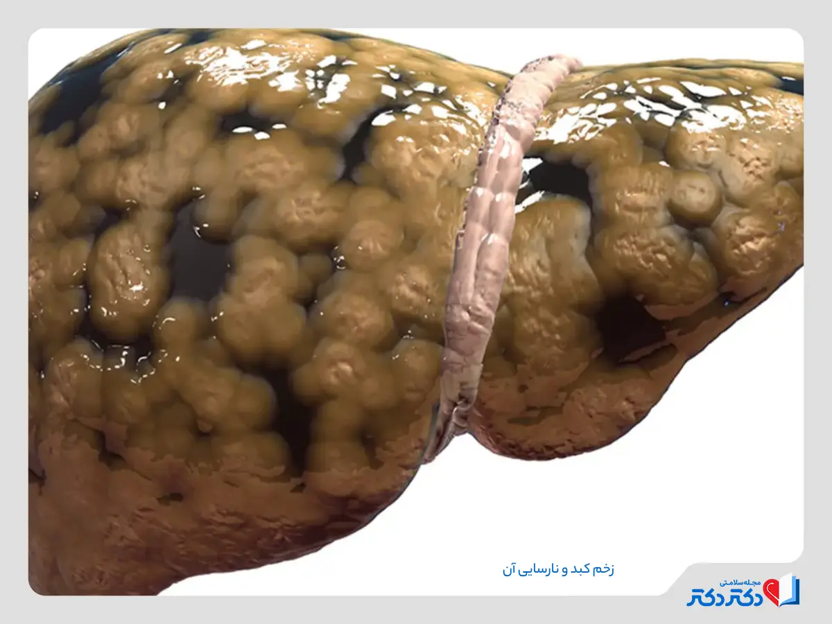 از کارافتادن کبد در اثر نارسایی کبدی