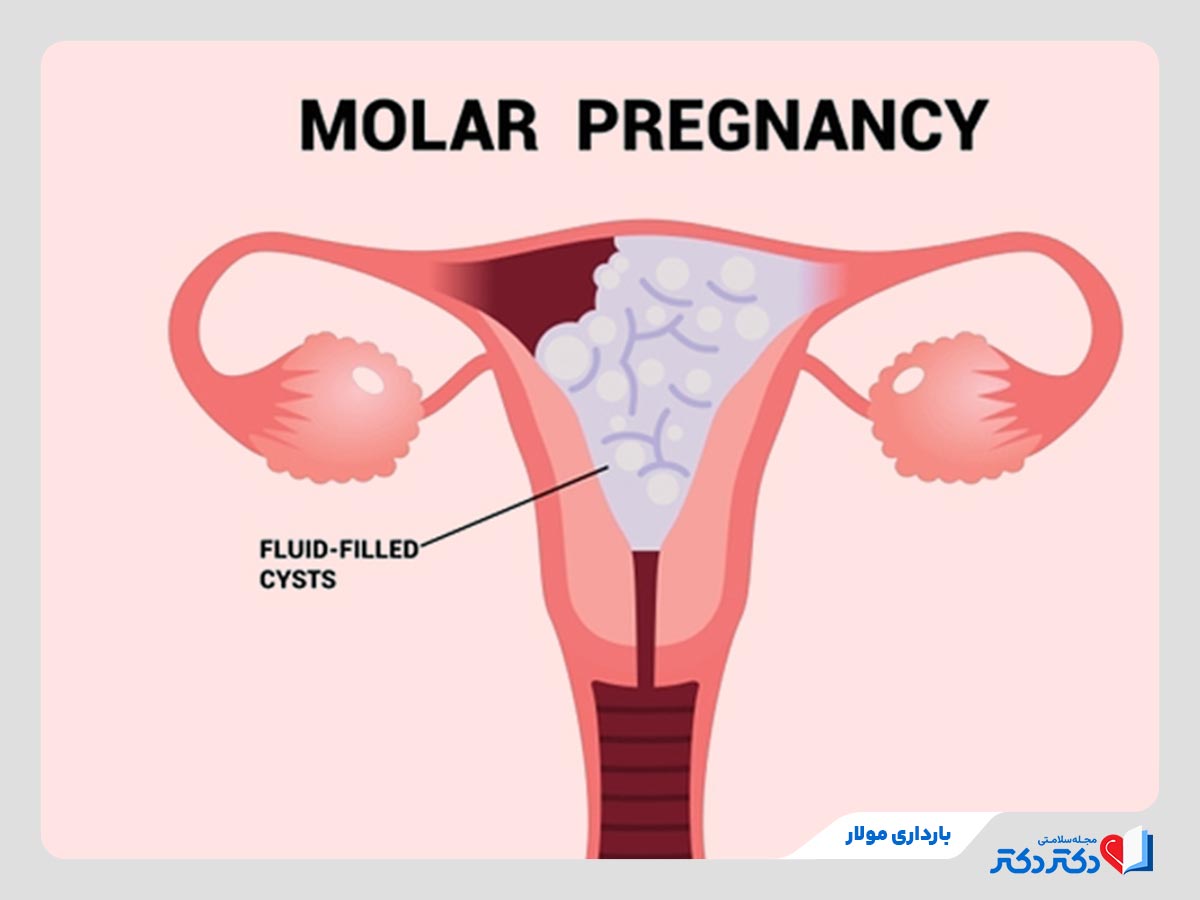 بارداری مولار از انواع بارداری نیازمند به مراقبت پزشکی