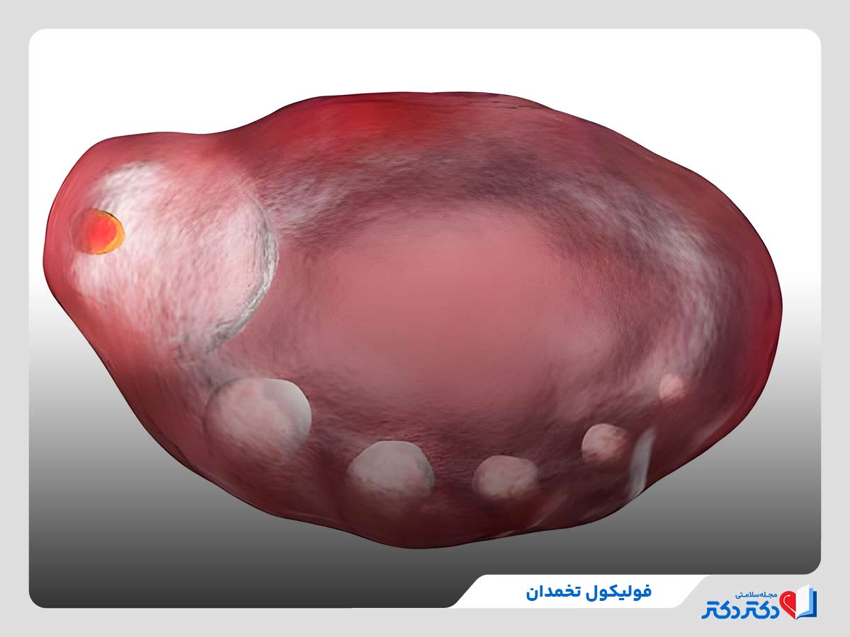 فولیکول تخمدان فولیکول غالب اختلال فولیکول تخمدان