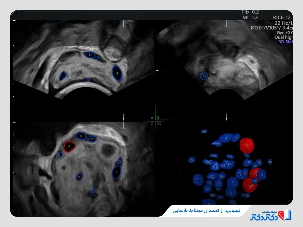 تصویری از تخمدان مبتلا به نارسایی