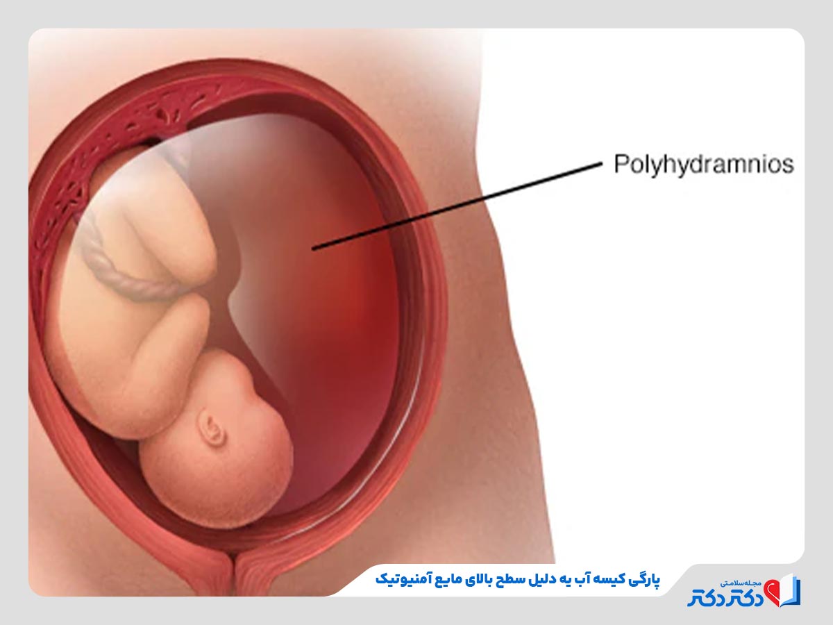 زیاد بودن مایع آمنیوتیک از عوامل اصلی پارگی کیسه آب جنین 