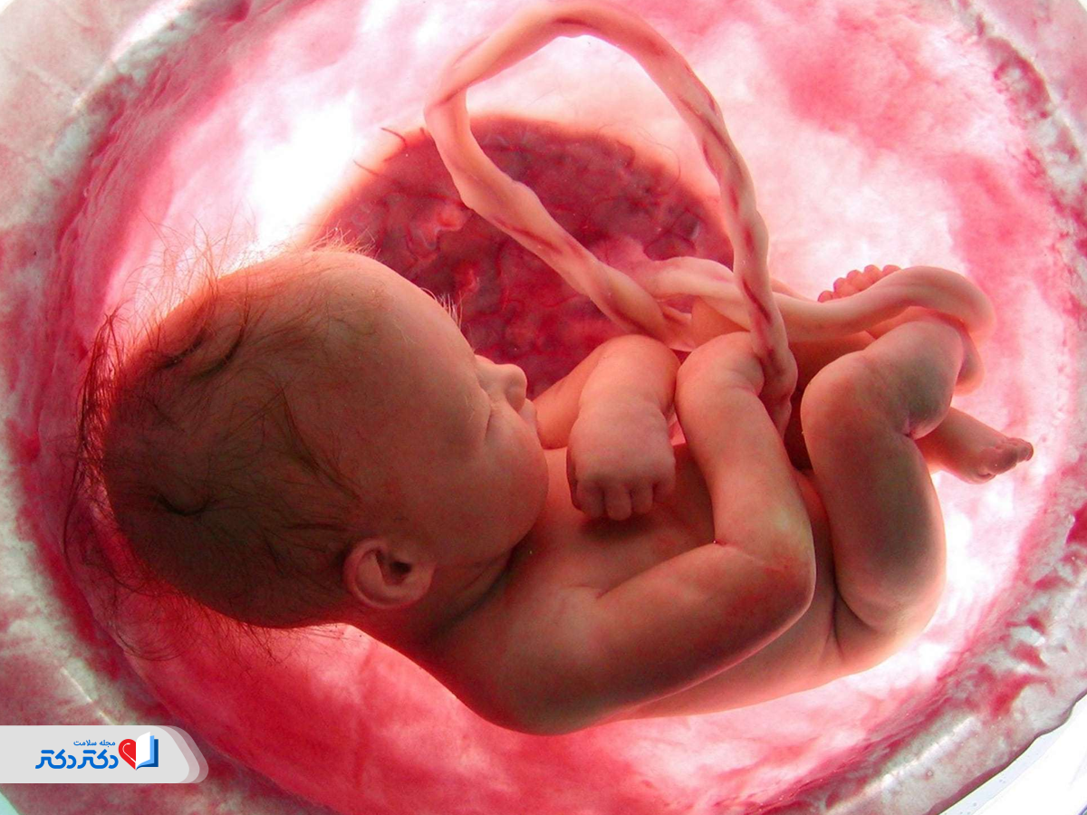 علائم پارگی کیسه آب جنین