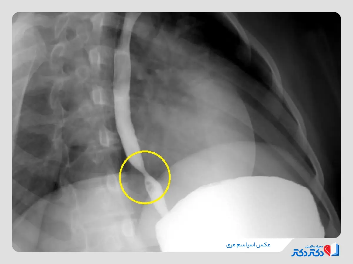 تشخیص اسپاسم مری با بررسی تصاویر سی تی اسکن