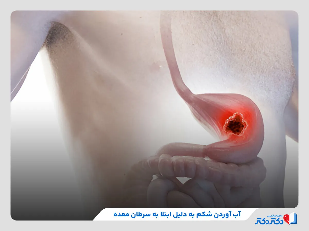 ابتلا به سرطان معده یکی از دلایل بروز آب آوردن شکم