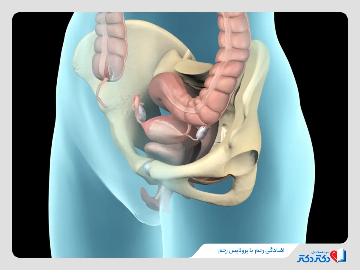افتادگی رحم پرولاپس رحم علت افتادگی رحم